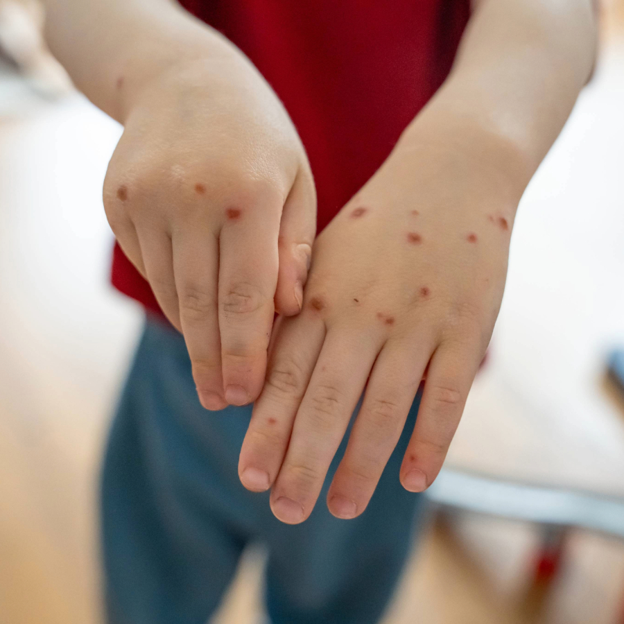 <p>Ar masalām slimo pulkam pievienojies vēl viens bērns</p>
<p>&nbsp;</p>