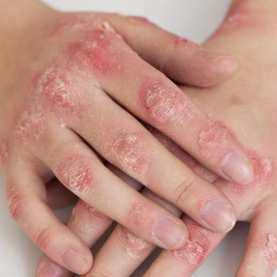 <p>Rīgas 1. slimnīca aicina bez maksas veikt psoriāzes pārbaudi</p>