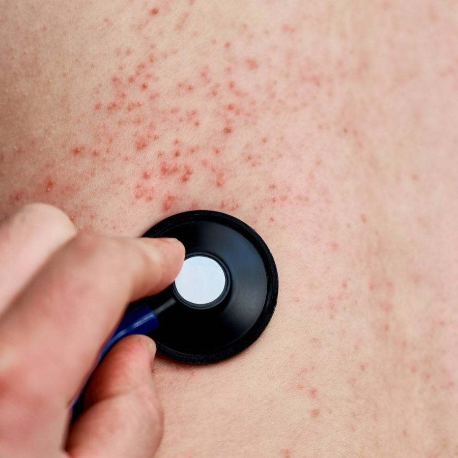 <p>Masalu uzliesmojumā saslimu&scaron;o skaits pieaudzis līdz 31</p>