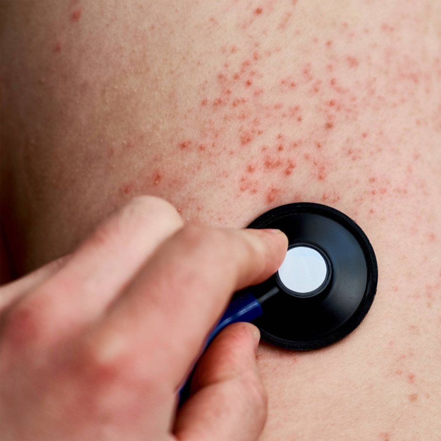 <p>Latvijā reģistrētais masalu uzliesmojums, vērtējams kā nopietns</p>