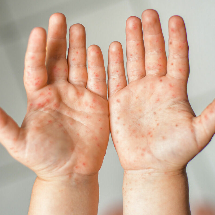 <p>Latvijā reģistrēts masalu uzliesmojums</p>